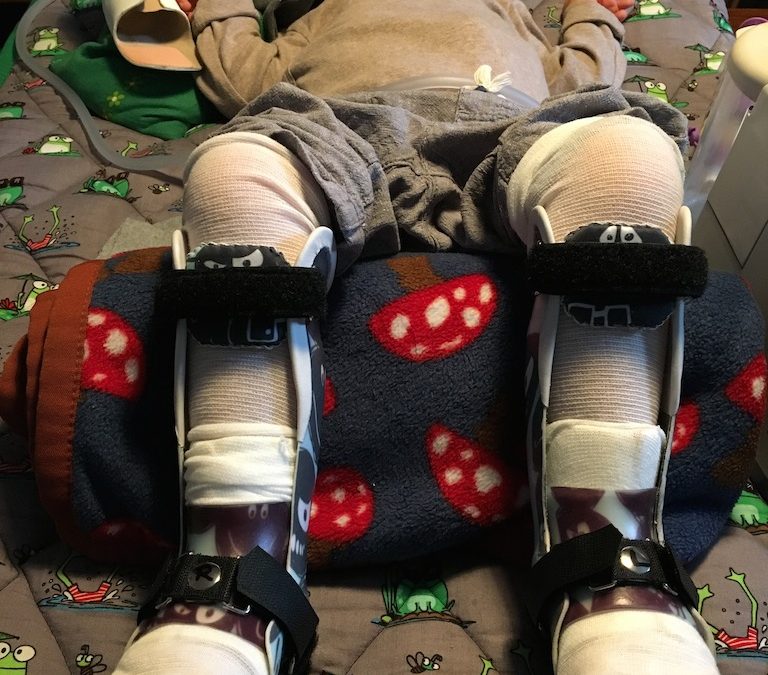 Meine ersten Orthesen – Teil 2